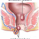 Illustration for article titled cara mengobati wasir ambeien dalamem/em